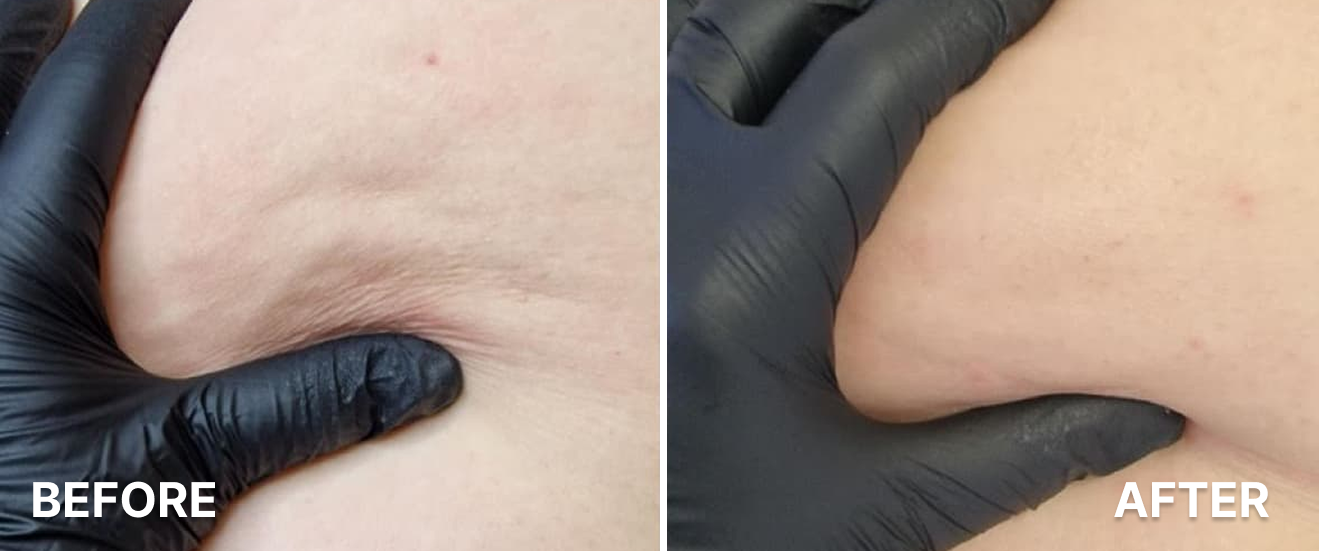 Ultrasound-Cavitation-RF-for-Thighs-1